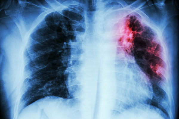 tubercolosi polmoni