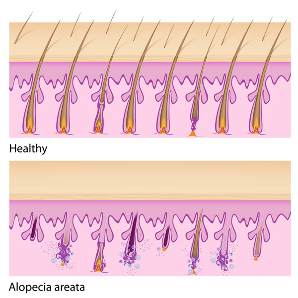 alopecia follicoli