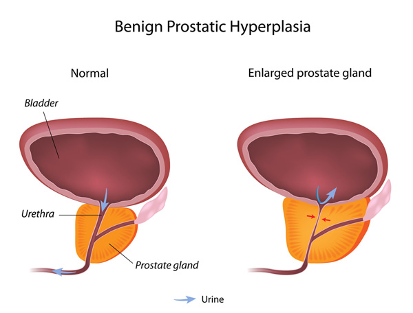 prostata infografica2