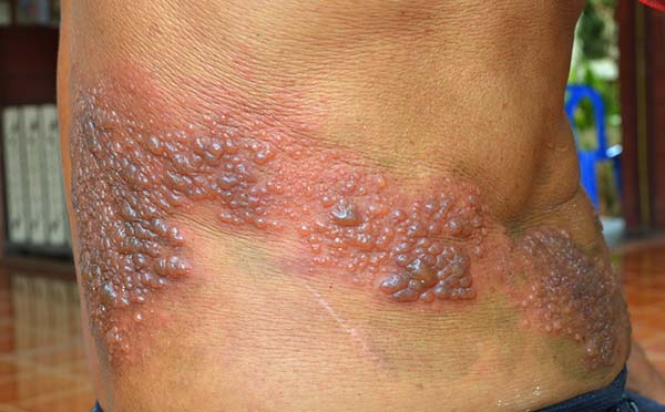 herpes zoster copia