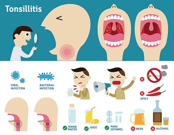 tonsillite infografica