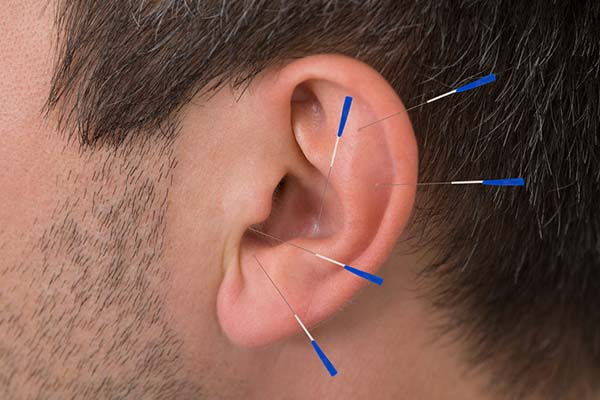agopuntura aghi orecchie
