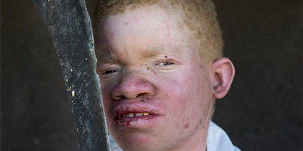 albinismo malawi 01