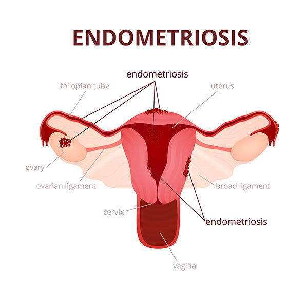 endometriosi infografica