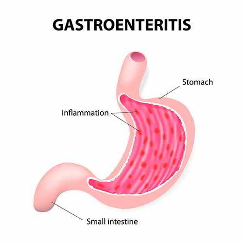 gastroenterite infografica