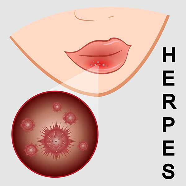herpes 2