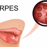 Herpes labiale