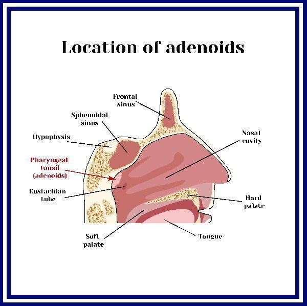 adenoidi naso