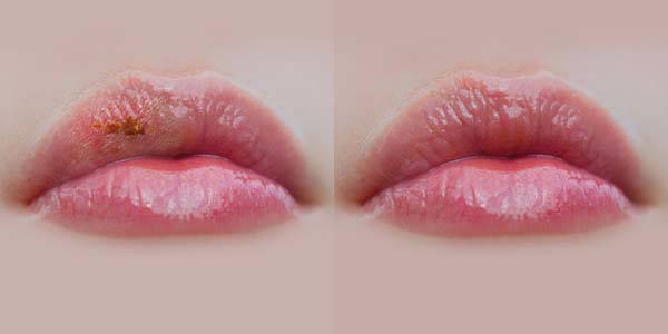 herpes-rossetto