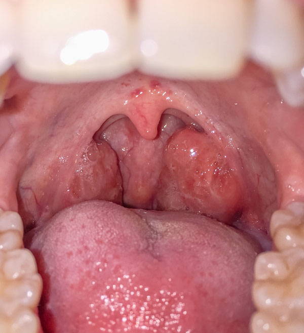 tonsille gonfie