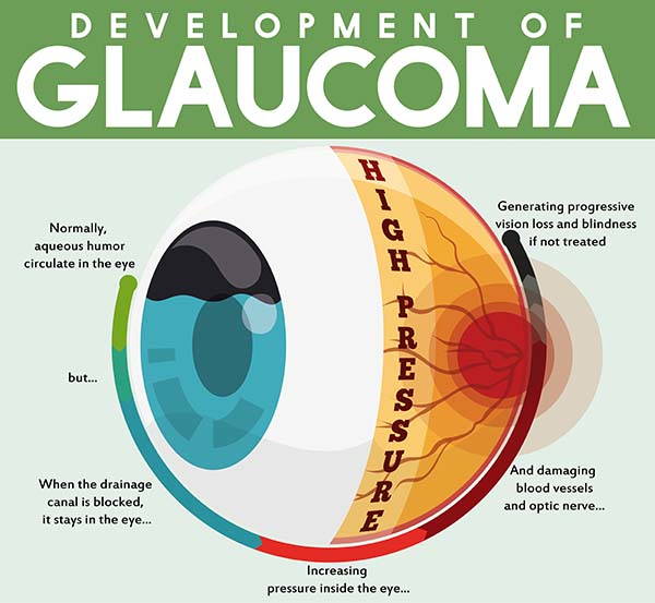 glaucoma infografica