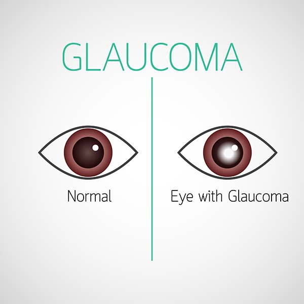 glaucoma infografica2