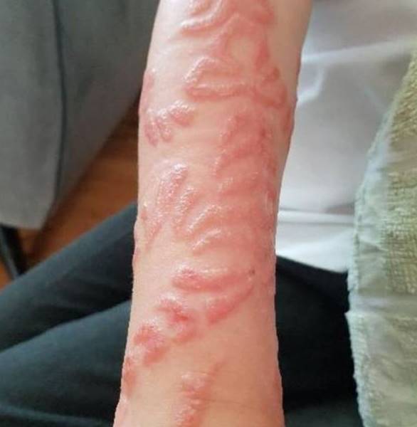 tatuaggio allergie