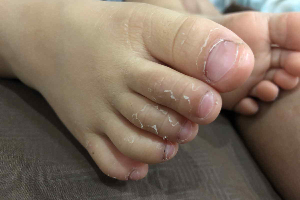 piedi malattia kawasaki