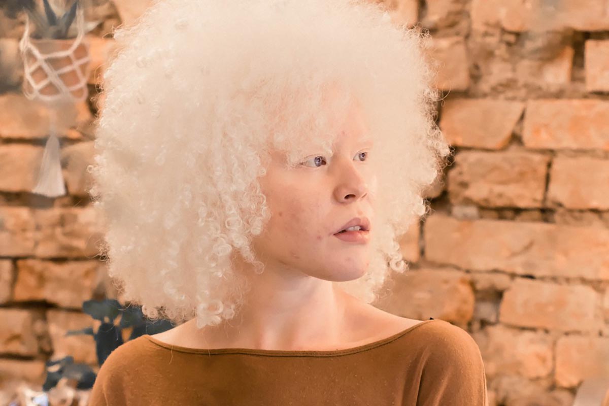 Ana Beatriz Ferreira albina ipovedente
