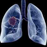 cancro ai polmoni rischio contaminanti