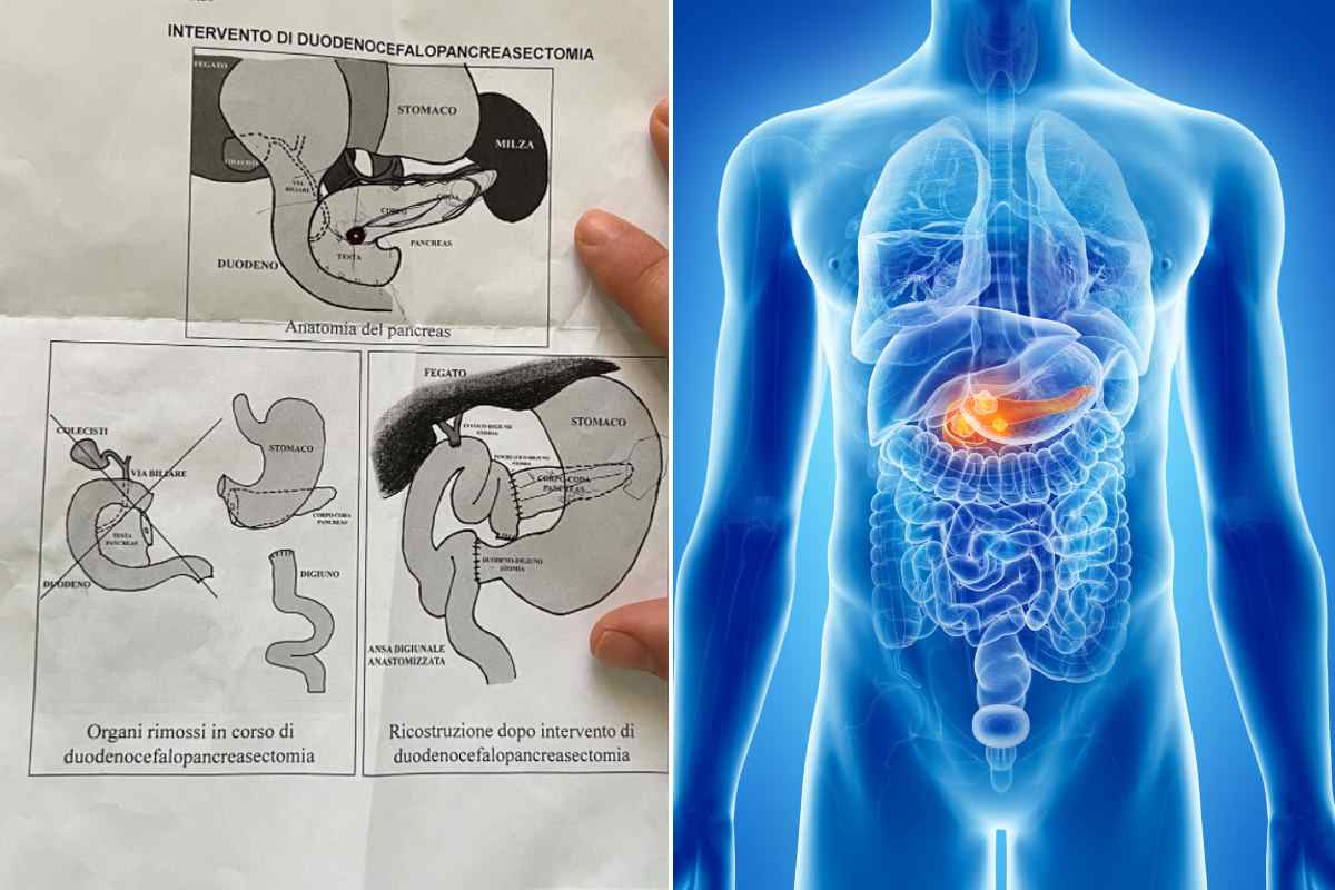 pancreas tumore
