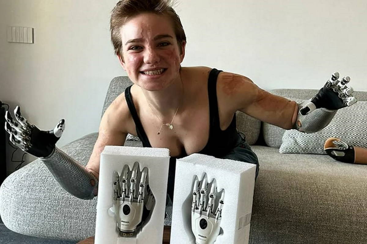 bebe vio nuove mani bioniche