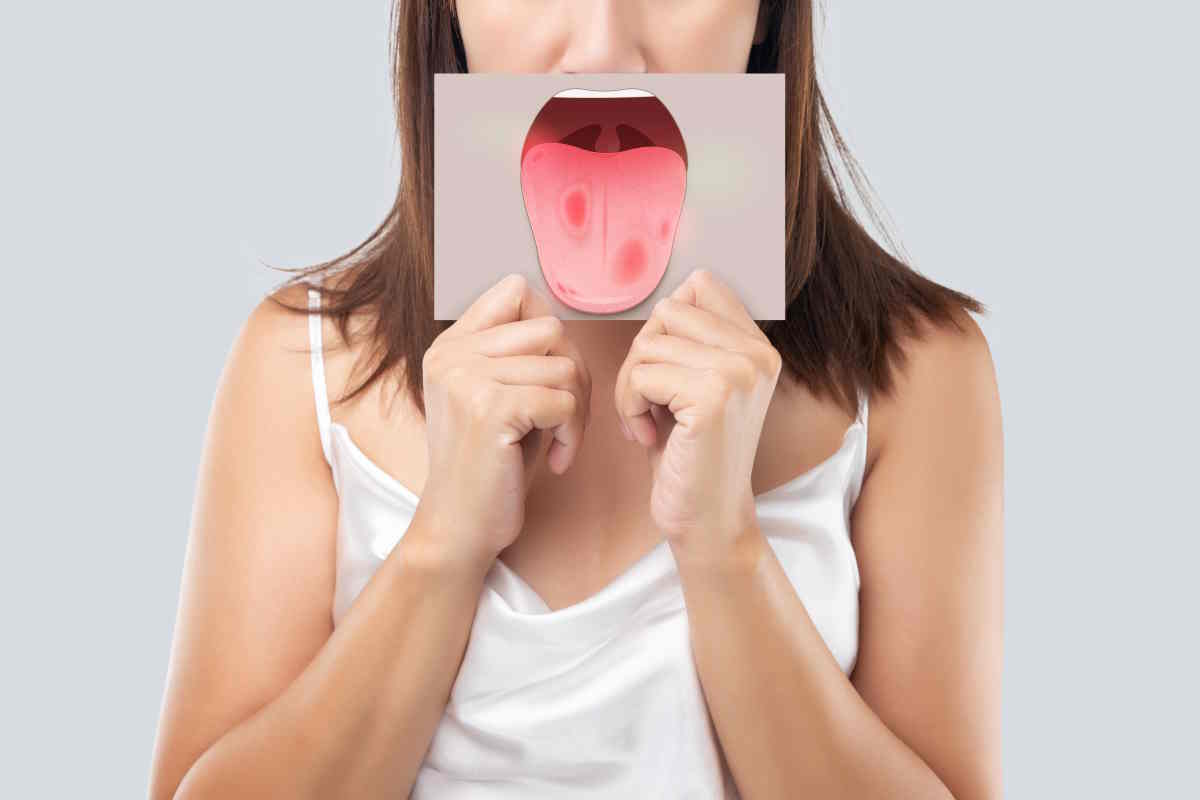 cancro alla lingua