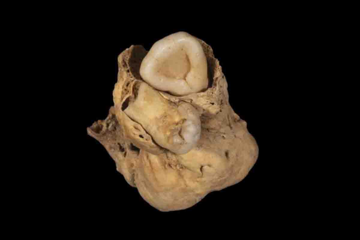 Eles pensaram que era um feto, mas este fóssil semelhante a um dente acabou por ser o tumor mais antigo do mundo